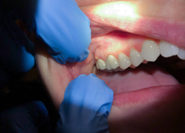 Best Dental Abscess Treatment in Gray, TN